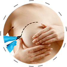 img-mamoplastia-hover